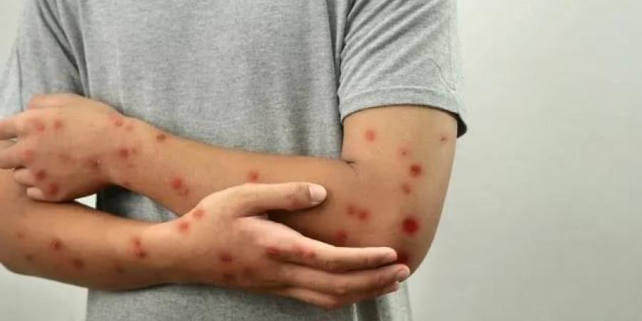 غينيا تتجاوز 300 إصابة مؤكدة بجدري القرود وسط حالة طوارئ صحية عامة - بلس 48
