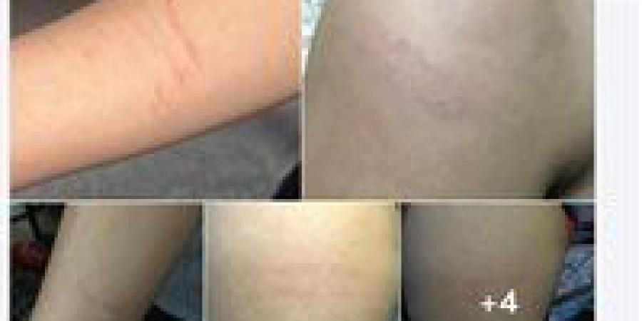 معلمة
      تعتدى
      على
      طالب
      بـ«العكاز»
      ... - بلس 48
