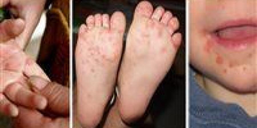 ما
      هو
      فيروس
      HFMD
      الذي
      تسبب
      في
     ... - بلس 48